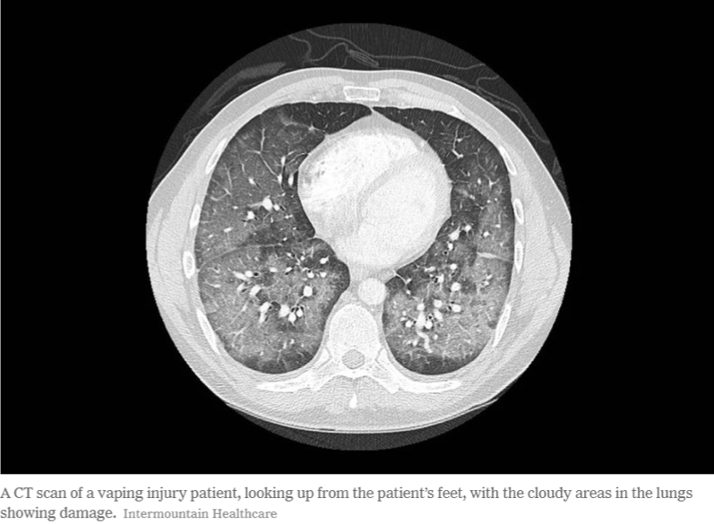 Lung illness